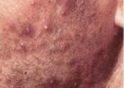 maleface prevents razor bumps, ingrown hairs