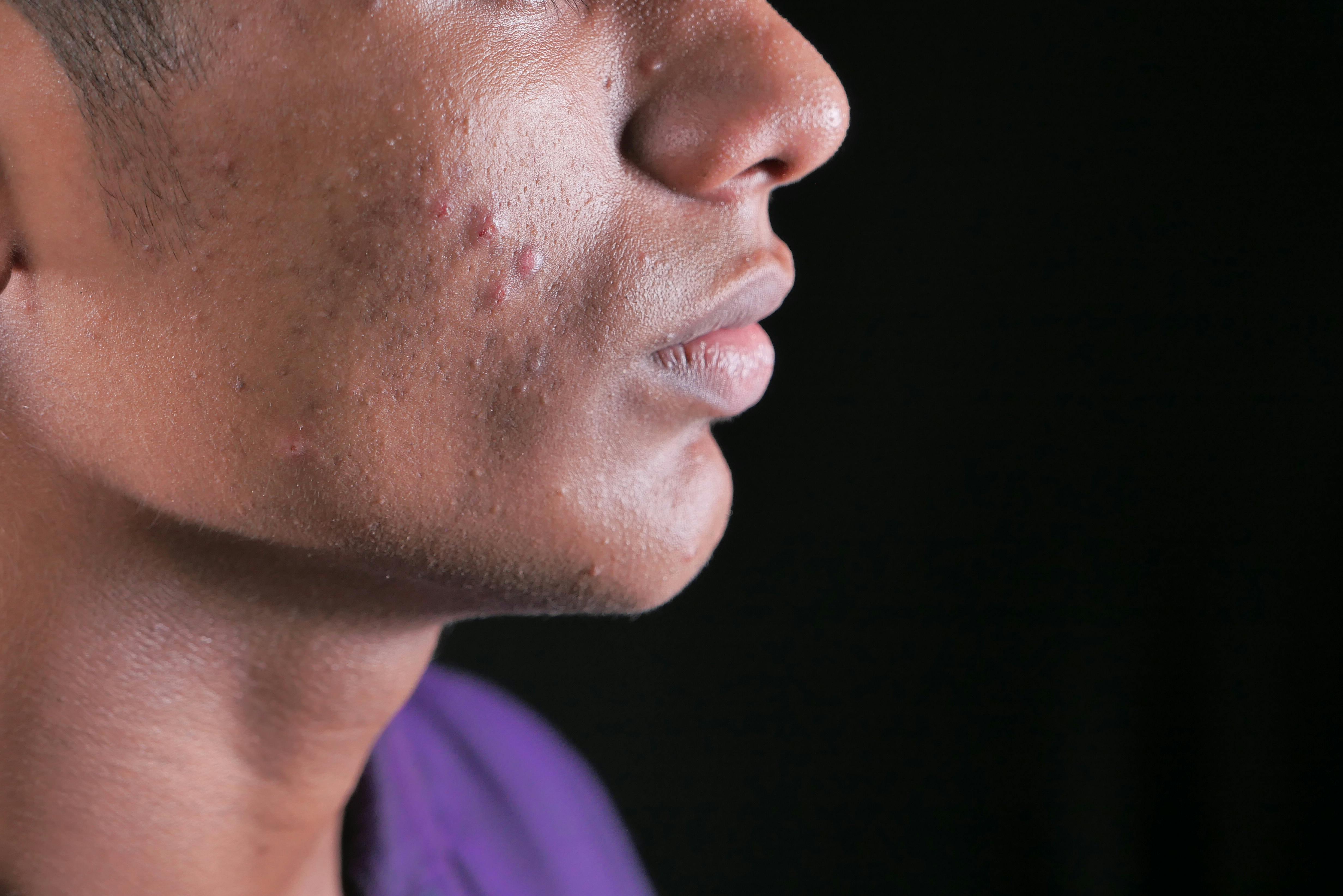 How to Remove Blackheads: Causes, Prevention.